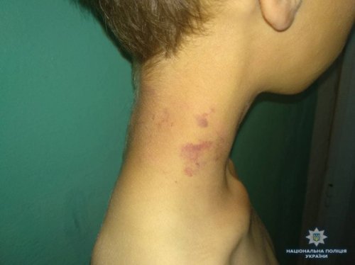 В Луганской области отчим избивал ребенка, приковав его цепью к кровати